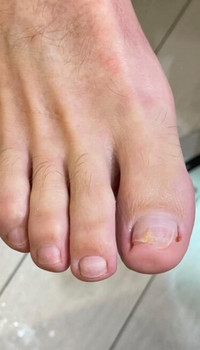 Herstelde nagel na 7 maanden tiptoe behandeling