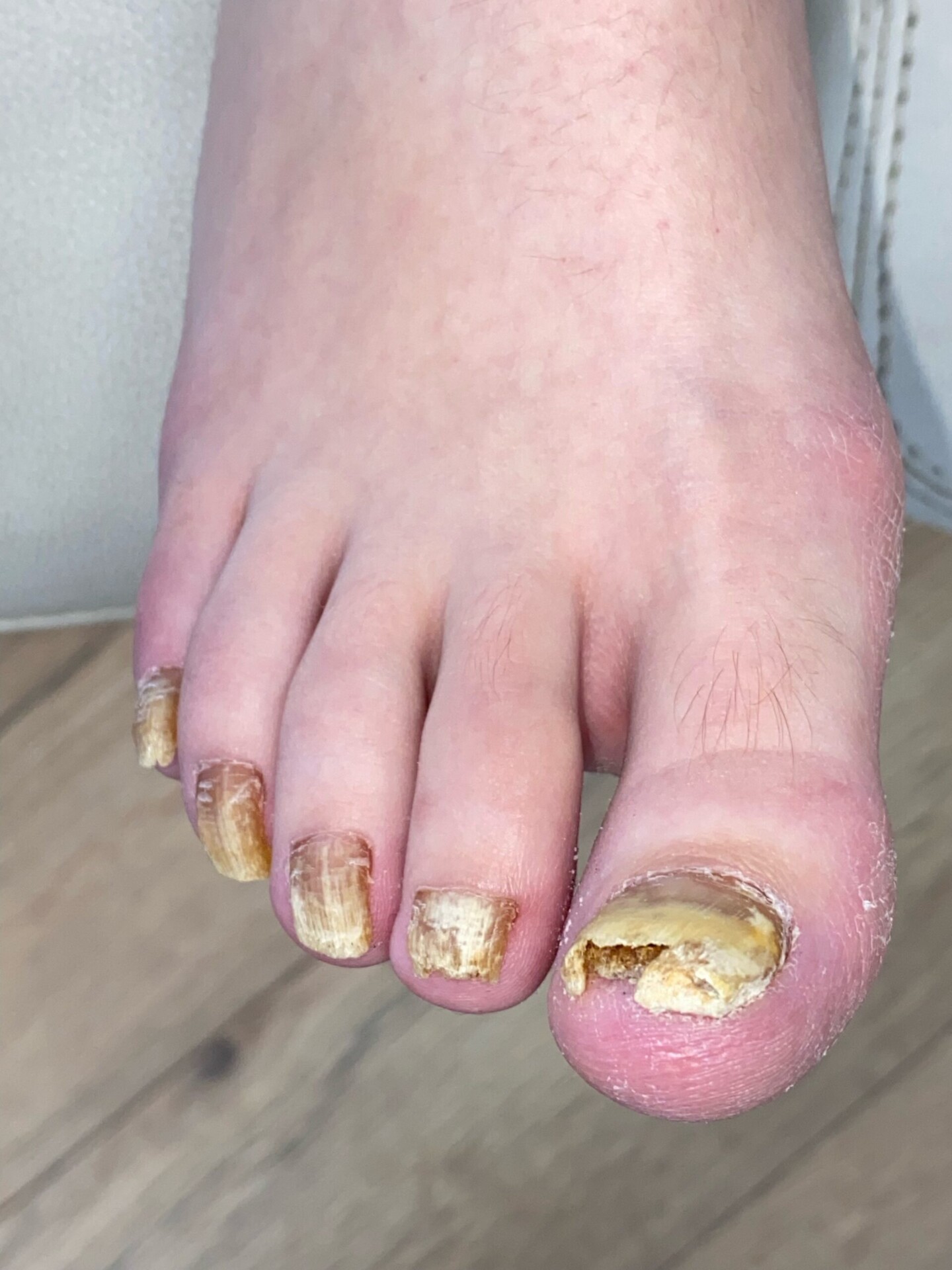 Kalknagel voor de tiptoe behandeling