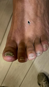 Aangetaste kalknagel voor de tiptoe behandeling