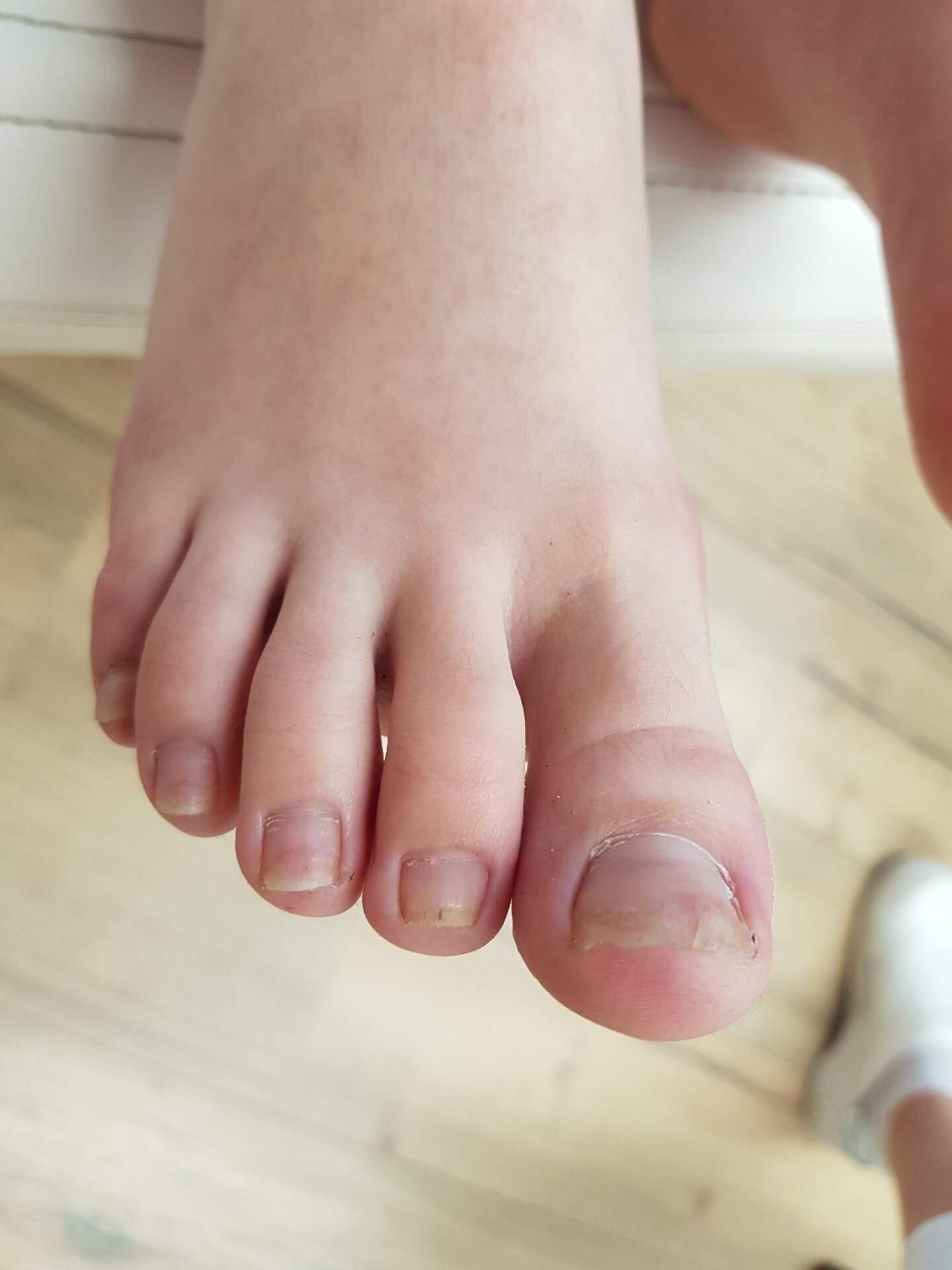 Gezonde tenen na 12 maanden tiptoe behandeling