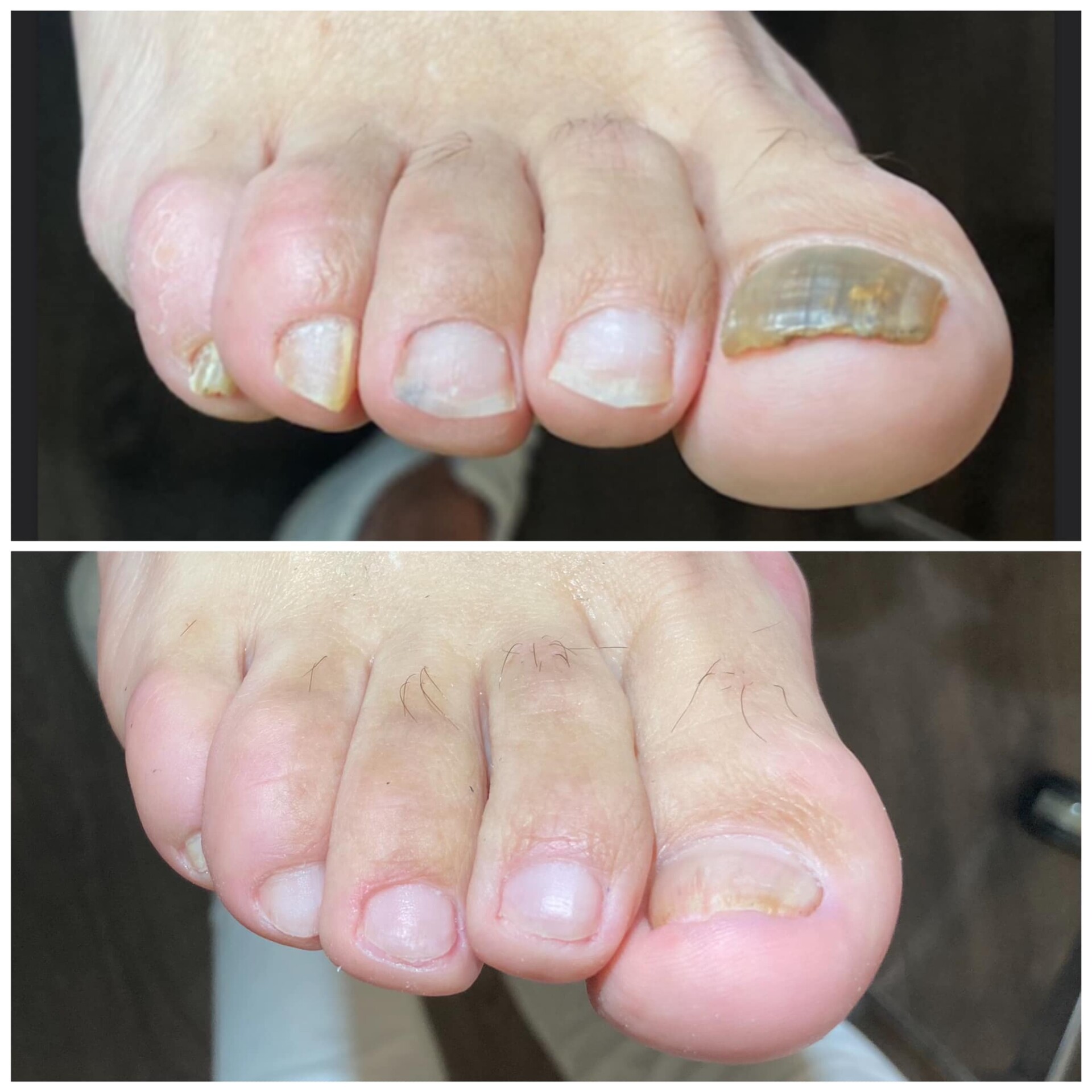 Voor- en na-foto van een kalknagelbehandeling bij tiptoe