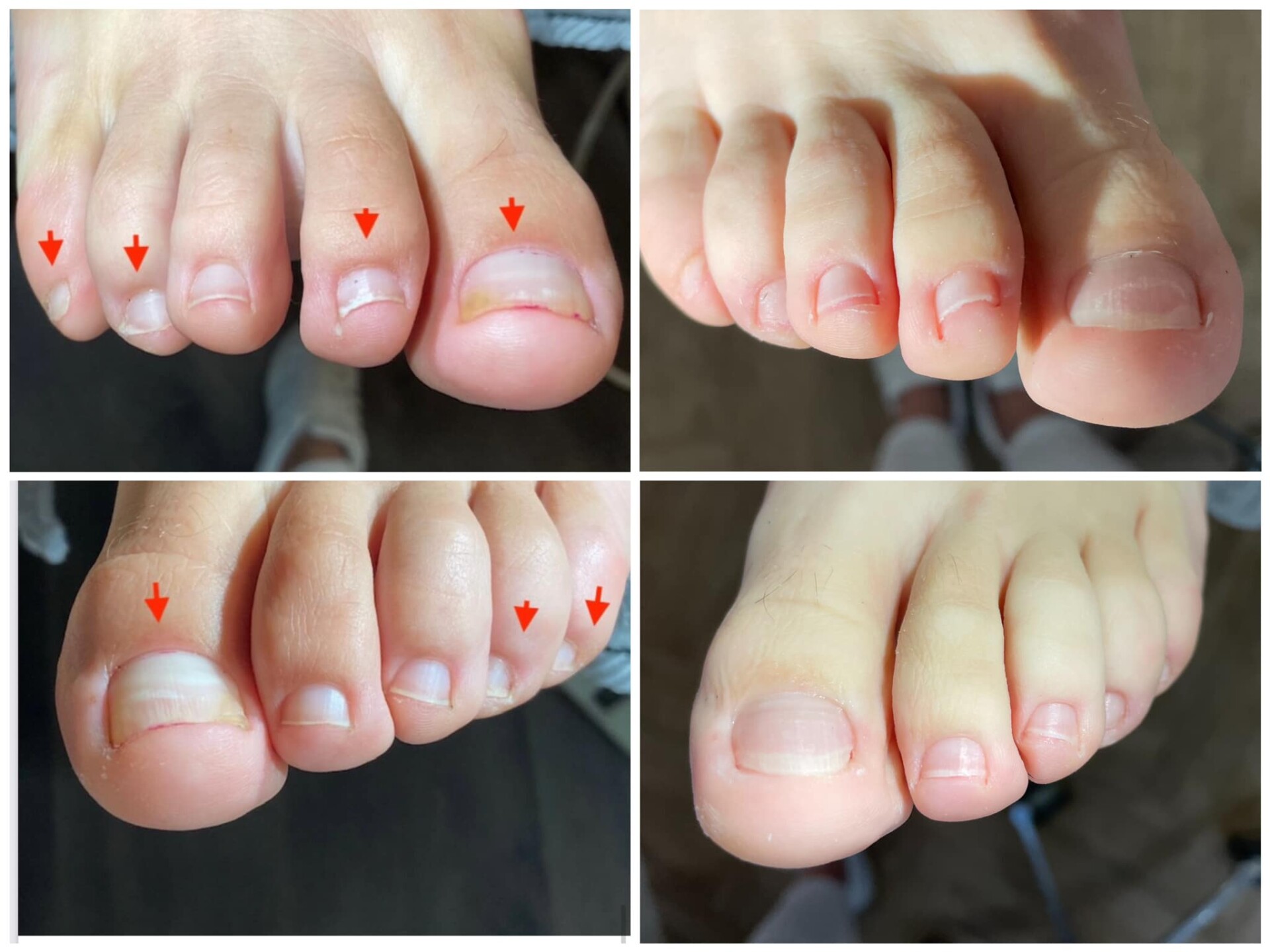 Voor- en na-foto van een kalknagelbehandeling bij tiptoe