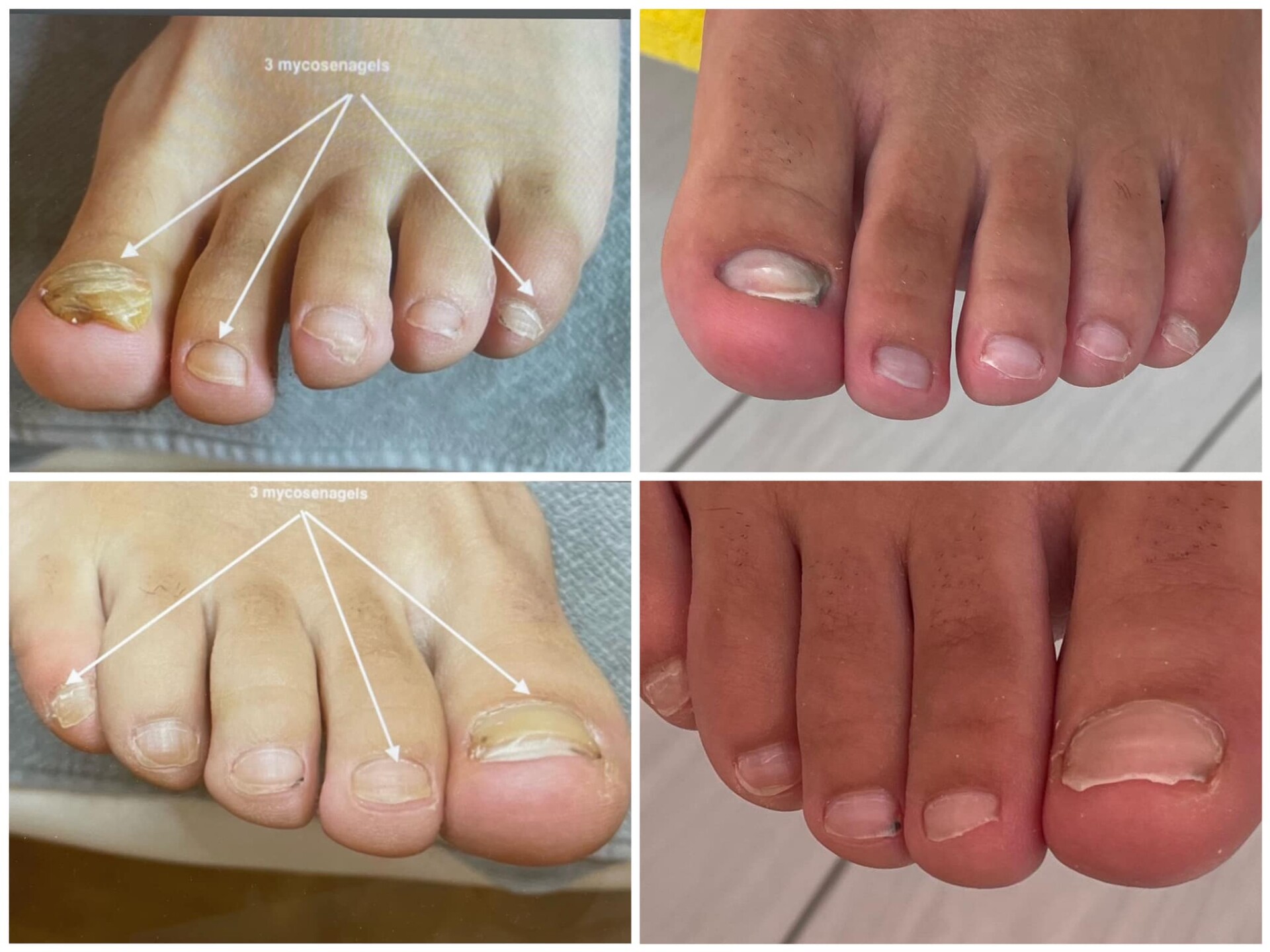 Voor- en na-foto van een kalknagelbehandeling bij tiptoe