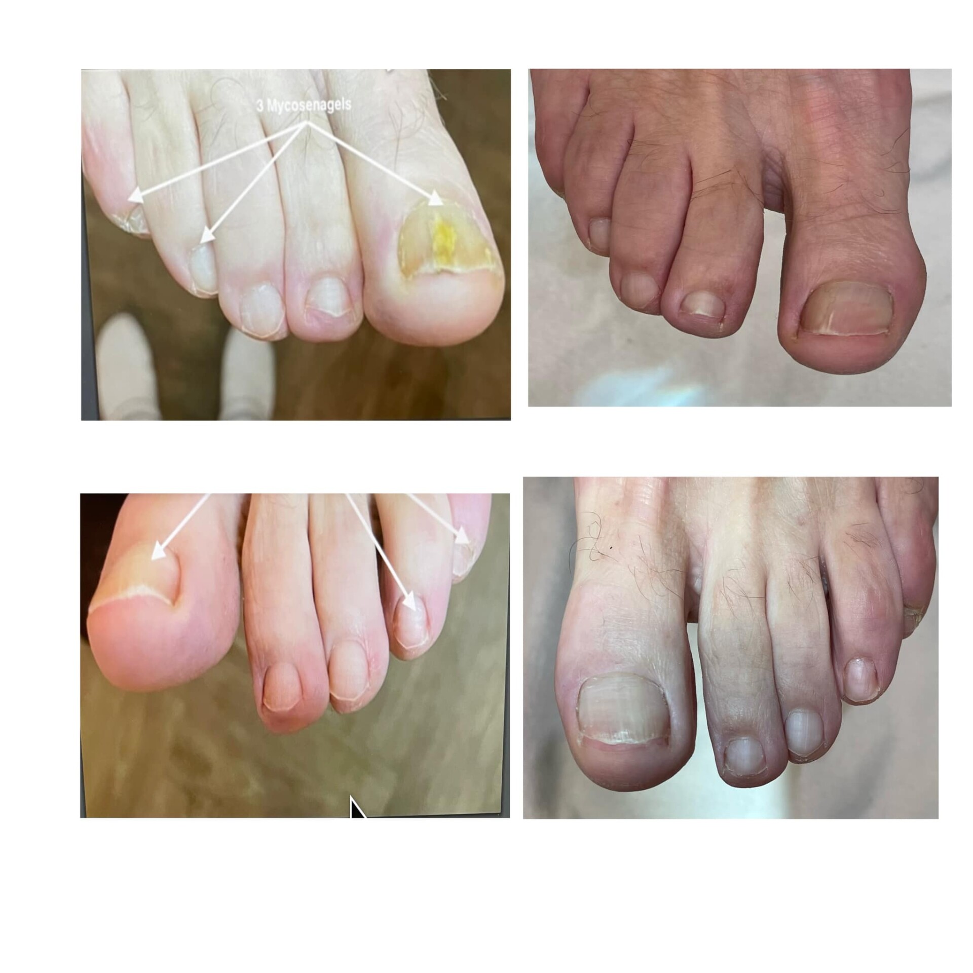 Voor- en na-foto van een kalknagelbehandeling bij tiptoe