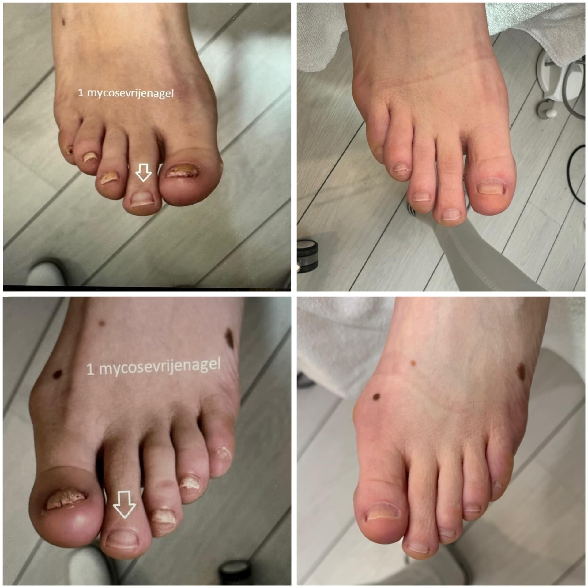 Voor- en na-foto van een kalknagelbehandeling bij tiptoe