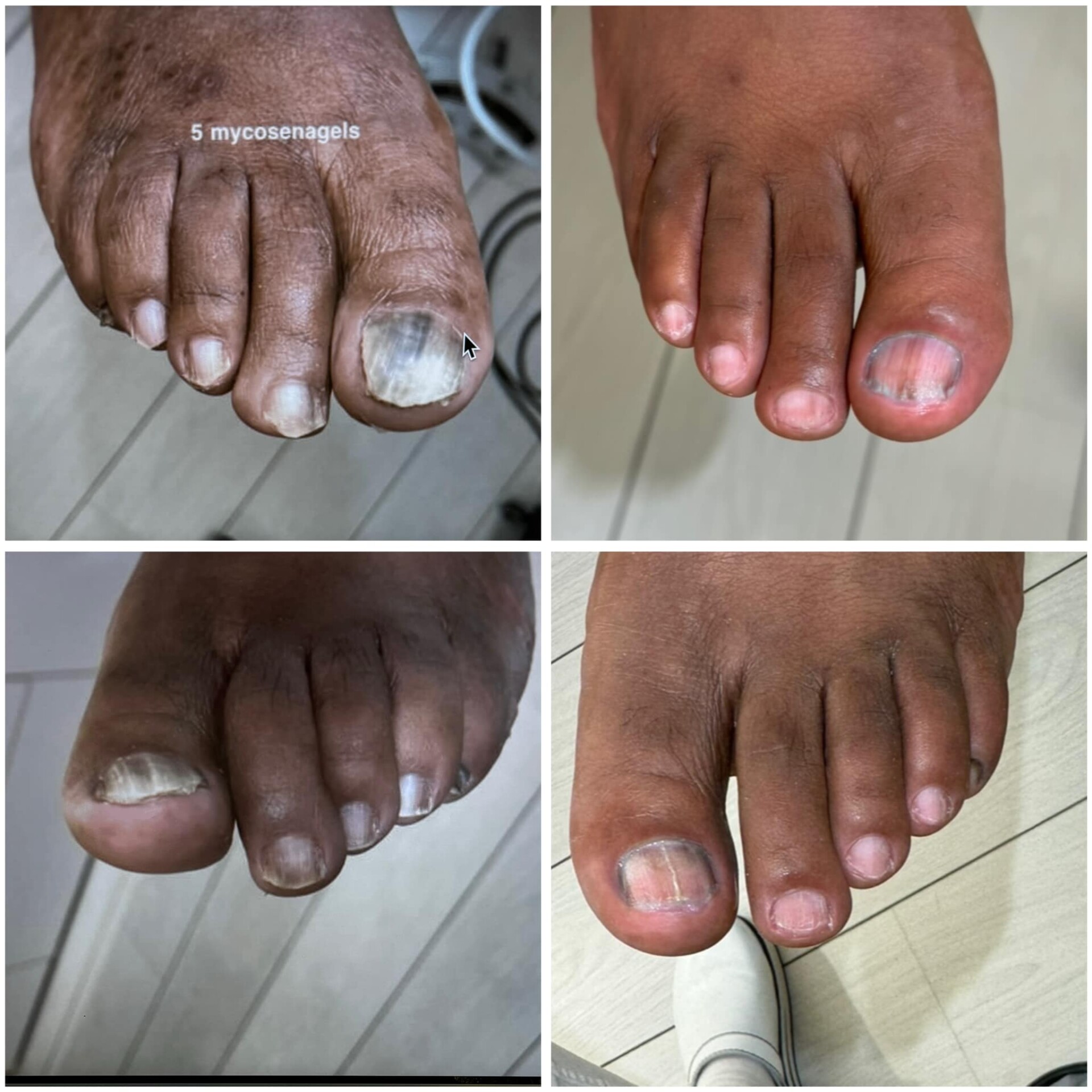 Voor- en na-foto van een kalknagelbehandeling bij tiptoe