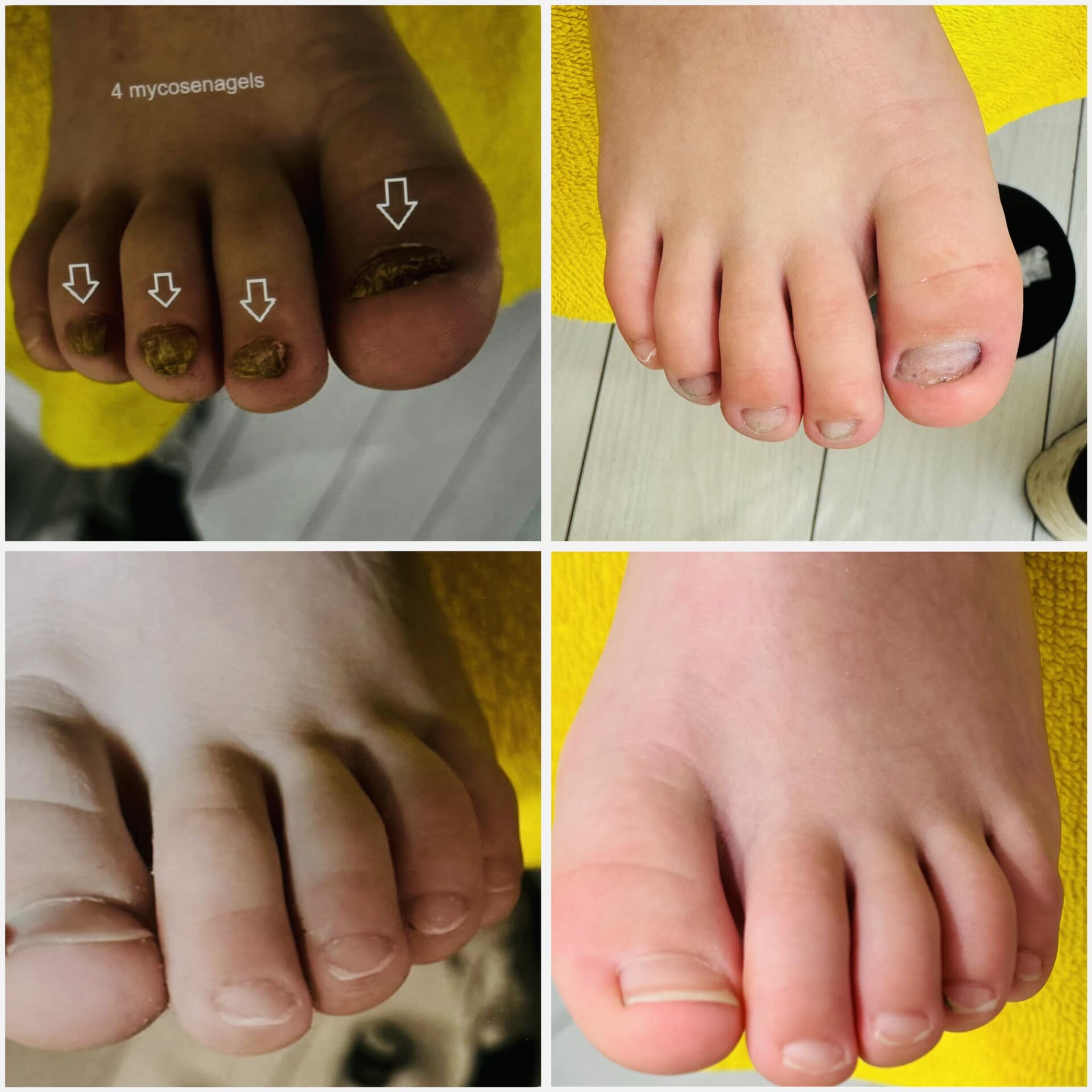Voor- en na-foto van een kalknagelbehandeling bij tiptoe