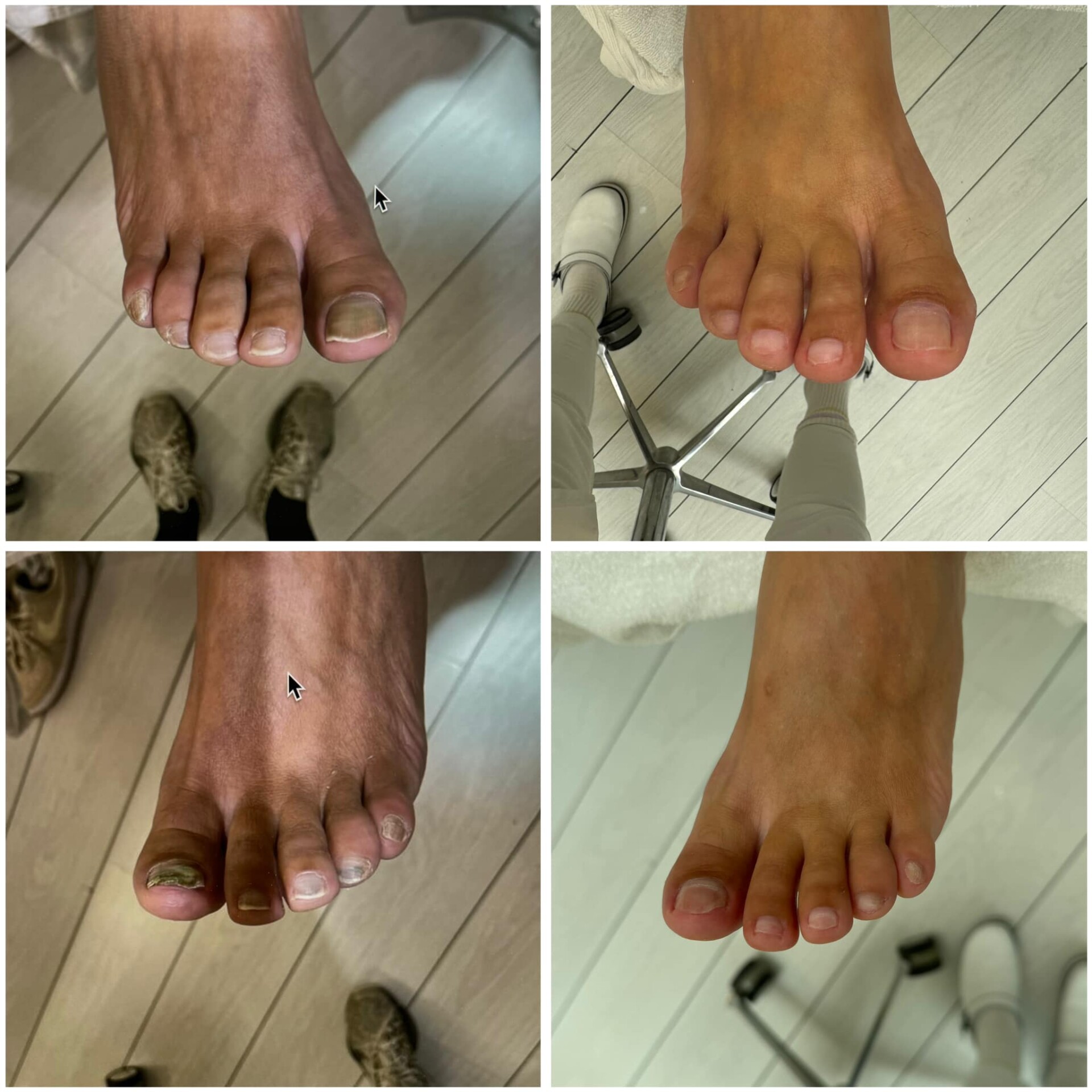 Voor- en na-foto van een kalknagelbehandeling bij tiptoe