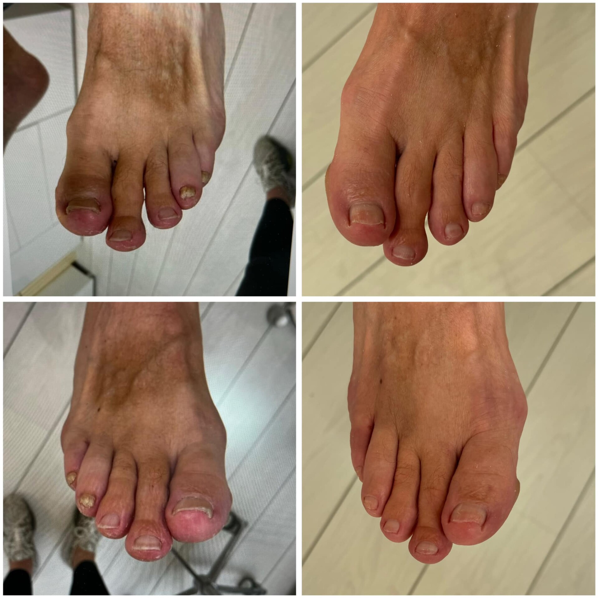 Voor- en na-foto van een kalknagelbehandeling bij tiptoe